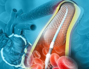 Angioplasty begins in government hospitals in Punjab