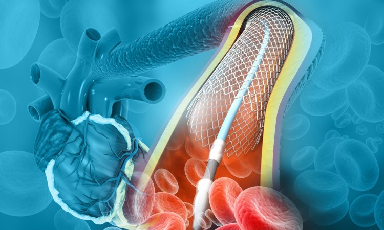 Angioplasty begins in government hospitals in Punjab