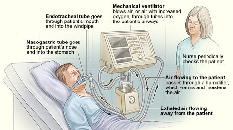 Ventilators_feat