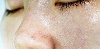 get rid of oily skin