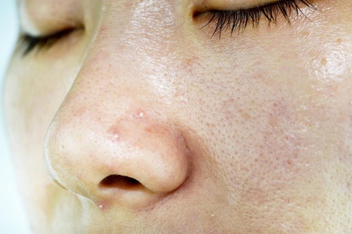 get rid of oily skin