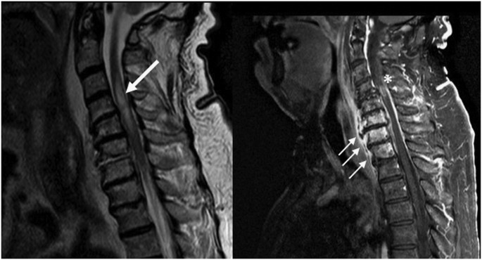 According To Research, A Neurological Condition Has Been Linked To Covid-19