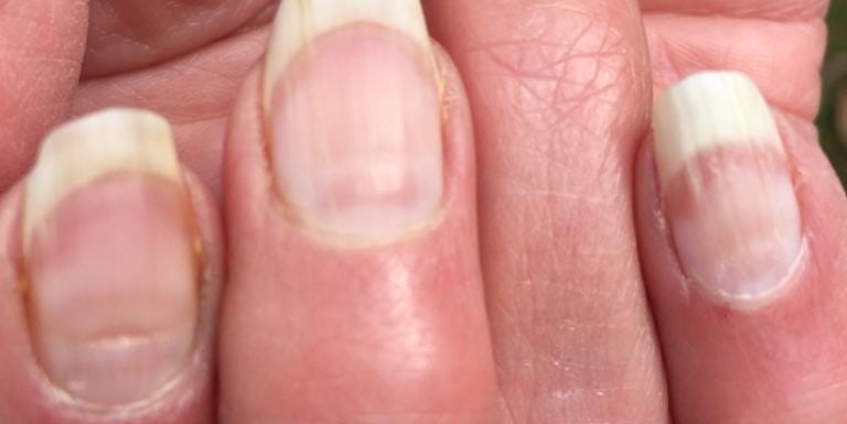 5 Things You Need To Know About 'COVID Nails'