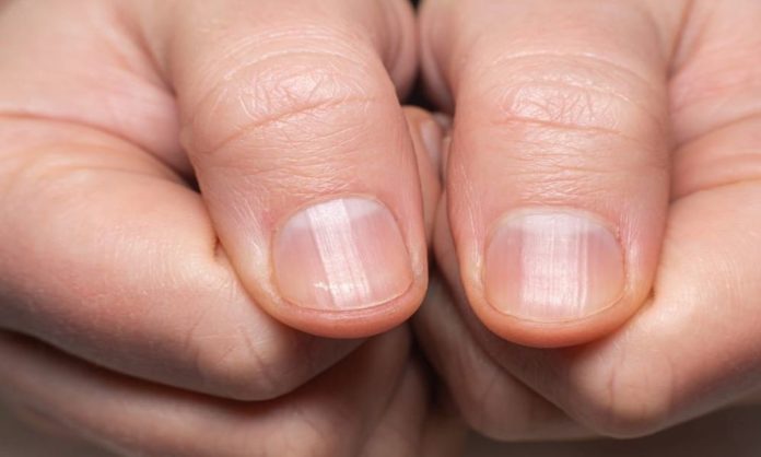 5 Things You Need To Know About 'COVID Nails'