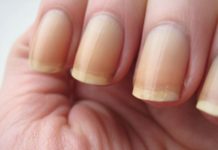 5 Fool-Proof Ways To Get Rid Of Yellow Nails At Home