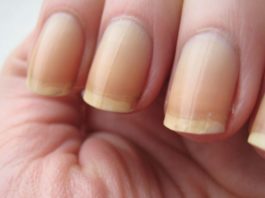 5 Fool-Proof Ways To Get Rid Of Yellow Nails At Home