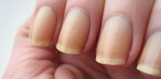 5 Fool-Proof Ways To Get Rid Of Yellow Nails At Home