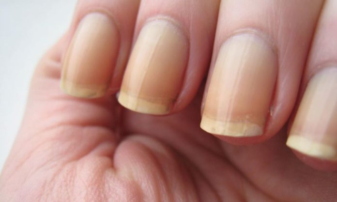 5 Fool-Proof Ways To Get Rid Of Yellow Nails At Home