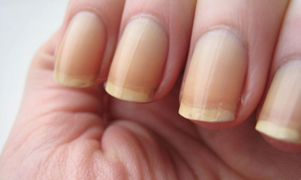 5 Fool-Proof Ways To Get Rid Of Yellow Nails At Home