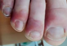 COVID TOE- A Side Effect Of Covid-19
