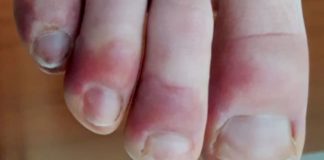 COVID TOE- A Side Effect Of Covid-19