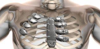 Surgeons To Use 3D Printers to Create Replacement Ribs