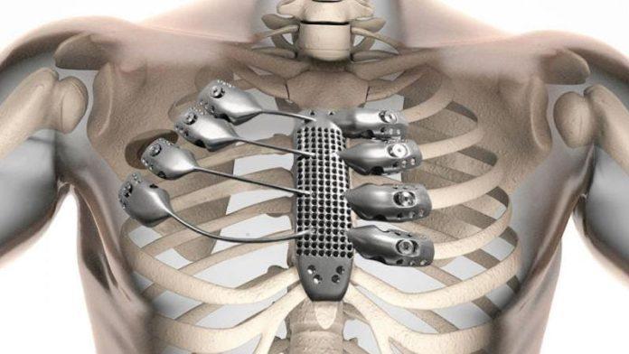 Surgeons To Use 3D Printers to Create Replacement Ribs