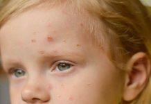 monkeypox symptoms