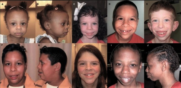 Children with William's Syndrome