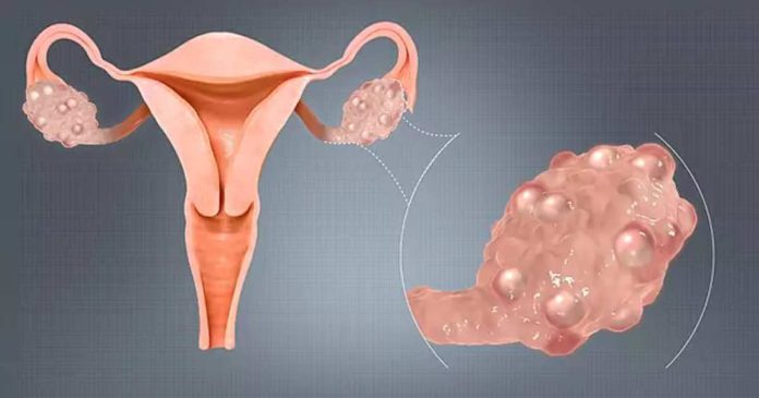 : PCOS name change, metabolic health, hormonal disorder, Monash University study, endocrine health, women's health 2026. PMOS